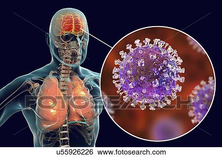 Stock Photograph - Encephalitis and pneumonia caused by Nipah viruses, computer illustration. Nipah virus is zoonotic (transmitted to humans from animals) and was first found in Malaysia and Singapore in people who had close contact with pigs. It was initially isolated.... Fotosearch