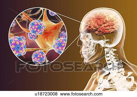 Encephalitis caused by enteroviruses, computer illustration. Enteroviruses are RNA (ribonucleic acid) viruses from the Picornaviridae family. They cause infections of different locations, including infections of the central nervous system. View Large Photo Image Stock Photo - Encephalitis caused by enteroviruses, computer illustration. Enteroviruses are RNA (ribonucleic acid) viruses from the Picornaviridae family. They cause infections of different locations, including infections of the central nervous system.. Fotosearch