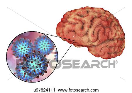 Stock Image - Encephalitis caused by measles viruses, computer illustration. This virus, from the Morbillivirus group of viruses, consists of an RNA (ribonucleic acid) core surrounded by an envelope studded with surface proteins haemagglutinin-neuraminidase and.... Fotosearch