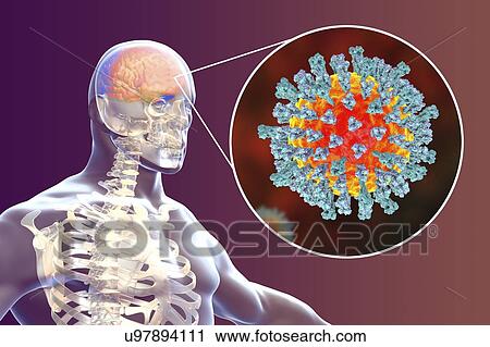 Stock Image - Encephalitis caused by measles viruses, computer illustration. This virus, from the Morbillivirus group of viruses, consists of an RNA (ribonucleic acid) core surrounded by an envelope studded with surface proteins haemagglutinin-neuraminidase and.... Fotosearch