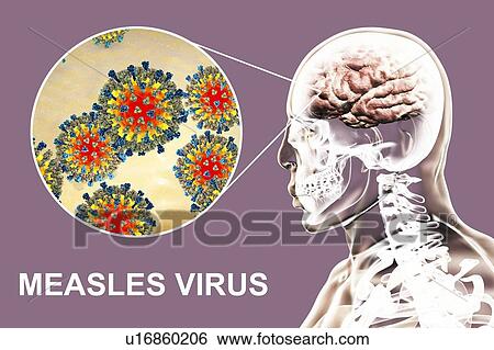 Stock Photograph - Encephalitis caused by measles viruses, computer illustration. This virus, from the Morbillivirus group of viruses, consists of an RNA (ribonucleic acid) core surrounded by an envelope. The envelope is studded with surface proteins.... Fotosearch