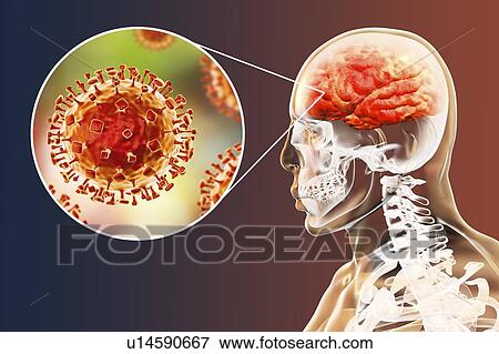 Stock Photo - Encephalitis caused by Nipah viruses, computer illustration. Nipah virus is zoonotic (transmitted to humans from animals) and was first found in Malaysia and Singapore in people who had close contact with pigs. It was initially isolated in 1999 upon.... Fotosearch