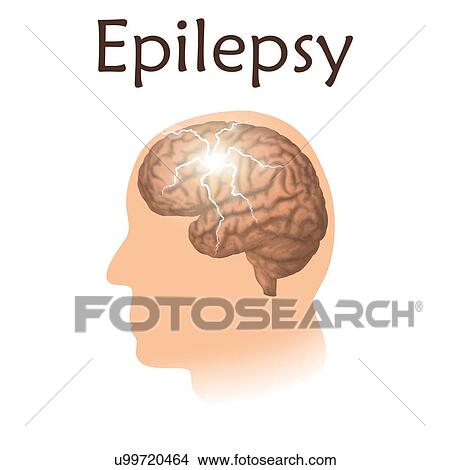 Picture - Epilepsy, illustration. Electrical discharge in a brain.. Fotosearch