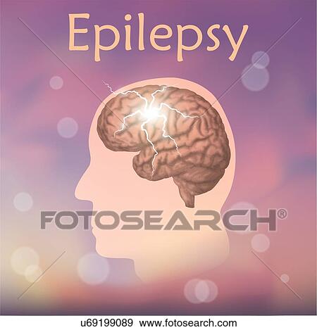 Epilepsy, illustration. Electrical discharge in a man's brain. View Large Photo Image Stock Photo - Epilepsy, illustration. Electrical discharge in a man's brain.. Fotosearch