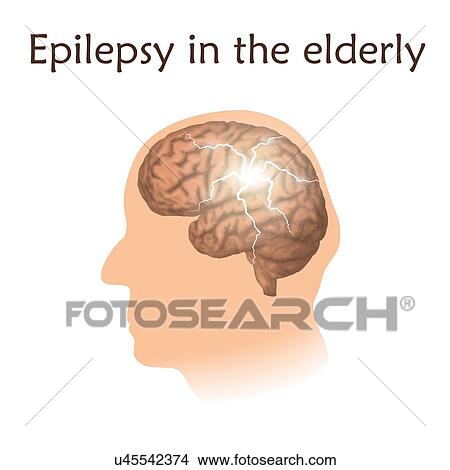 Picture - Epilepsy in the elderly, illustration. Electrical discharge in an old man's brain.. Fotosearch