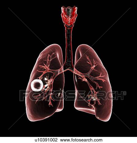 Fibrous-cavernous pulmonary tuberculosis. Computer illustration showing cavern (cavity) in the right lung with a well-formed fibrous layer in its wall. View Large Photo Image Stock Image - Fibrous-cavernous pulmonary tuberculosis. Computer illustration showing cavern (cavity) in the right lung with a well-formed fibrous layer in its wall.. Fotosearch