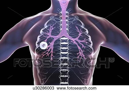 Stock Image - Fibrous-cavernous pulmonary tuberculosis. Computer illustration showing cavern (cavity) in the right lung with a well-formed fibrous layer in its wall.. Fotosearch