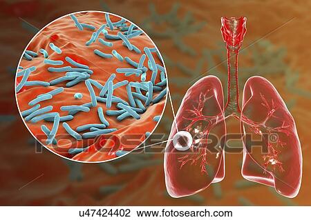 Fibrous-cavernous pulmonary tuberculosis and close-up view of Mycobacterium tuberculosis bacteria, the causative agent of tuberculosis. Computer illustration showing cavern (cavity) in the right lung with a well-formed fibrous layer in its wall. View Large Photo Image Stock Image - Fibrous-cavernous pulmonary tuberculosis and close-up view of Mycobacterium tuberculosis bacteria, the causative agent of tuberculosis. Computer illustration showing cavern (cavity) in the right lung with a well-formed fibrous layer in its wall.. Fotosearch