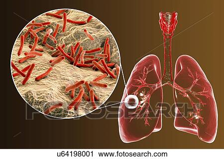 Fibrous-cavernous pulmonary tuberculosis and close-up view of Mycobacterium tuberculosis bacteria, the causative agent of tuberculosis. Computer illustration showing cavern (cavity) in the right lung with a well-formed fibrous layer in its wall. View Large Photo Image Stock Image - Fibrous-cavernous pulmonary tuberculosis and close-up view of Mycobacterium tuberculosis bacteria, the causative agent of tuberculosis. Computer illustration showing cavern (cavity) in the right lung with a well-formed fibrous layer in its wall.. Fotosearch