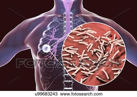 Stock Image - Fibrous-cavernous pulmonary tuberculosis and close-up view of Mycobacterium tuberculosis bacteria, the causative agent of tuberculosis. Computer illustration showing cavern (cavity) in the right lung with a well-formed fibrous layer in its wall.. Fotosearch