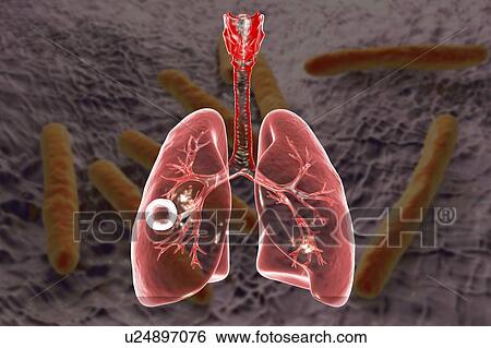 Fibrous-cavernous pulmonary tuberculosis. Computer illustration showing cavern (cavity) in the right lung with a well-formed fibrous layer in its wall. Image background represents illustration of Mycobacterium tuberculosis bacteria, the causative... View Large Photo Image Stock Photograph - Fibrous-cavernous pulmonary tuberculosis. Computer illustration showing cavern (cavity) in the right lung with a well-formed fibrous layer in its wall. Image background represents illustration of Mycobacterium tuberculosis bacteria, the causative.... Fotosearch