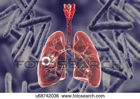 Fibrous-cavernous pulmonary tuberculosis. Computer illustration showing cavern (cavity) in the right lung with a well-formed fibrous layer in its wall. Image background represents illustration of Mycobacterium tuberculosis bacteria, the causative... View Large Photo Image Stock Photograph - Fibrous-cavernous pulmonary tuberculosis. Computer illustration showing cavern (cavity) in the right lung with a well-formed fibrous layer in its wall. Image background represents illustration of Mycobacterium tuberculosis bacteria, the causative.... Fotosearch