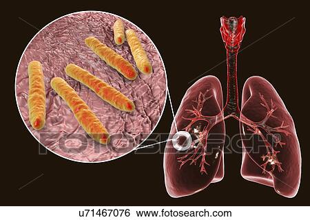 Fibrous-cavernous pulmonary tuberculosis and close-up view of Mycobacterium tuberculosis bacteria, the causative agent of tuberculosis. Computer illustration showing cavern (cavity) in the right lung with a well-formed fibrous layer in its wall. View Large Photo Image Stock Photograph - Fibrous-cavernous pulmonary tuberculosis and close-up view of Mycobacterium tuberculosis bacteria, the causative agent of tuberculosis. Computer illustration showing cavern (cavity) in the right lung with a well-formed fibrous layer in its wall.. Fotosearch