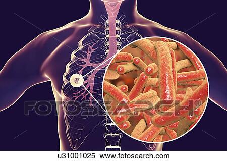 Fibrous-cavernous pulmonary tuberculosis and close-up view of Mycobacterium tuberculosis bacteria, the causative agent of tuberculosis. Computer illustration showing cavern (cavity) in the right lung with a well-formed fibrous layer in its wall. View Large Photo Image Stock Photography - Fibrous-cavernous pulmonary tuberculosis and close-up view of Mycobacterium tuberculosis bacteria, the causative agent of tuberculosis. Computer illustration showing cavern (cavity) in the right lung with a well-formed fibrous layer in its wall.. Fotosearch