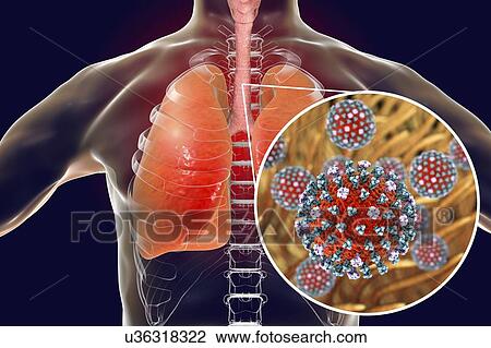 Flu viruses in trachea, computer illustration. Influenza viruses have tropism to tracheal epithelium, they decrease tracheal mucociliary velocity thus contributing to the development of secondary infections of the lower respiratory tract. Due to this,... View Large Photo Image Stock Image - Flu viruses in trachea, computer illustration. Influenza viruses have tropism to tracheal epithelium, they decrease tracheal mucociliary velocity thus contributing to the development of secondary infections of the lower respiratory tract. Due to this,.... Fotosearch