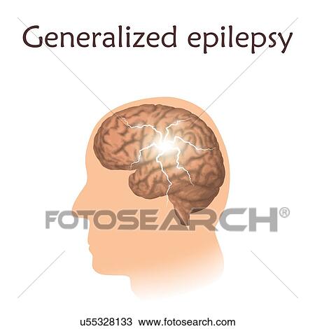 Focal epilepsy, illustration. Electrical discharge in a focused area of a man's brain. View Large Photo Image Stock Image - Focal epilepsy, illustration. Electrical discharge in a focused area of a man's brain.. Fotosearch