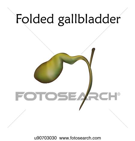 Stock Image - Folded gallbladder, illustration.. Fotosearch