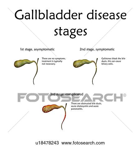 Stock Image - Gallbladder disease stages, illustration. The stages include inflammation and gallstone formation.. Fotosearch