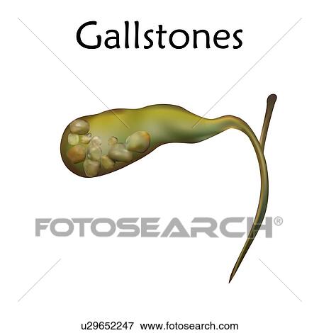 Stock Photo - Gallstones, illustration.. Fotosearch