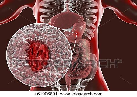 Gastric (stomach) ulcer, illustration. Gastric, or peptic, ulcers are erosions of the mucosal lining of the stomach. View Large Photo Image Stock Image - Gastric (stomach) ulcer, illustration. Gastric, or peptic, ulcers are erosions of the mucosal lining of the stomach.. Fotosearch