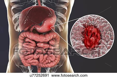 Gastric (stomach) ulcer, illustration. Gastric, or peptic, ulcers are erosions of the mucosal lining of the stomach. View Large Photo Image Stock Image - Gastric (stomach) ulcer, illustration. Gastric, or peptic, ulcers are erosions of the mucosal lining of the stomach.. Fotosearch