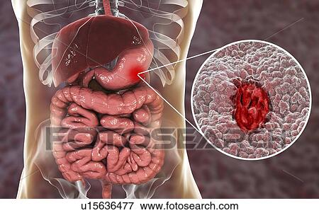 Gastric (stomach) ulcer, illustration. Gastric, or peptic, ulcers are erosions of the mucosal lining of the stomach. View Large Photo Image Stock Photo - Gastric (stomach) ulcer, illustration. Gastric, or peptic, ulcers are erosions of the mucosal lining of the stomach.. Fotosearch