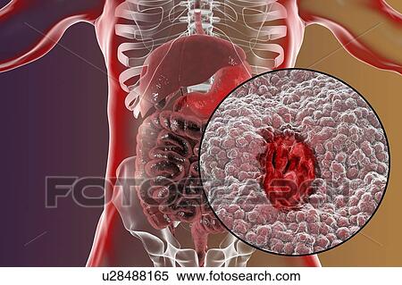 Stock Photography - Gastric (stomach) ulcer, illustration. Gastric, or peptic, ulcers are erosions of the mucosal lining of the stomach.. Fotosearch
