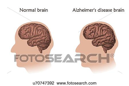 Stock Image - Generalized epilepsy, illustration. Electrical discharge throughout a man's brain.. Fotosearch