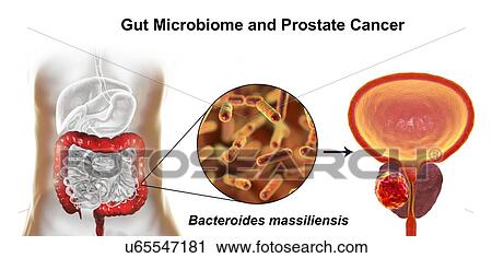 Stock Image - Gut microbiome and prostate cancer. Conceptual illustration showing the association of Bacteroides massiliensis bacteria in the large intestine with prostate cancer development.. Fotosearch