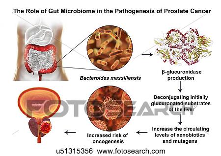 Stock Photograph - Gut microbiome and prostate cancer. Conceptual illustration showing the association of Bacteroides massiliensis bacteria in the large intestine with prostate cancer development.. Fotosearch