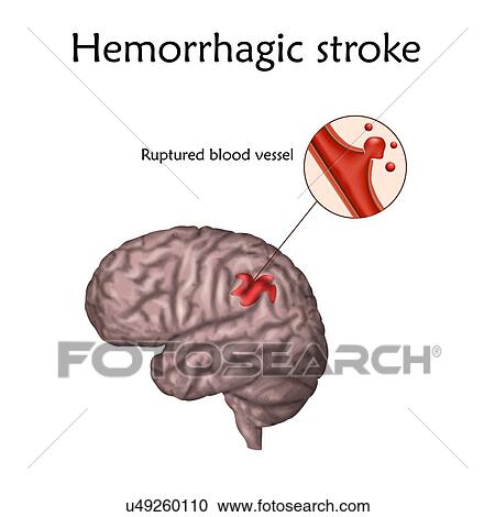 Stock Image - Haemorrhagic stroke. Illustration of a ruptured blood vessel in the brain causing a stroke.. Fotosearch