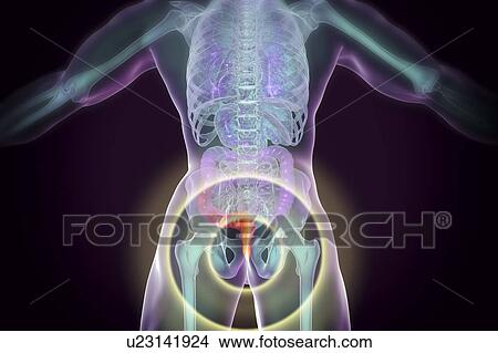 Picture - Haemorrhoids. Computer illustration of a rear view of the human body with external haemorrhoids in the anus.. Fotosearch