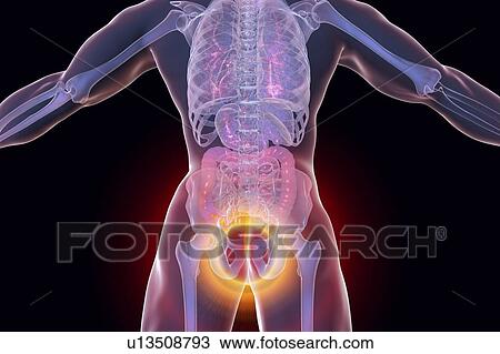 Stock Image - Haemorrhoids. Computer illustration of a rear view of the human body with external haemorrhoids in the anus.. Fotosearch