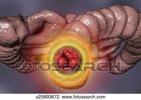 Stock Image - Haemorrhoids. Computer illustration of human intestines from below with haemorrhoids in the anus.. Fotosearch