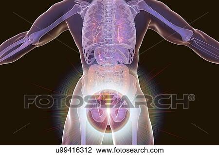 Haemorrhoids. Computer illustration of a rear view of the human body with external haemorrhoids in the anus. View Large Photo Image Stock Image - Haemorrhoids. Computer illustration of a rear view of the human body with external haemorrhoids in the anus.. Fotosearch