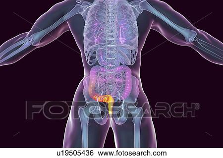 Stock Photograph - Haemorrhoids. Computer illustration of a rear view of the human body with external haemorrhoids in the anus.. Fotosearch