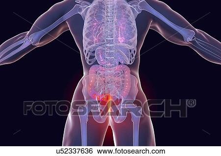 Haemorrhoids. Computer illustration of a rear view of the human body with external haemorrhoids in the anus. View Large Photo Image Stock Photograph - Haemorrhoids. Computer illustration of a rear view of the human body with external haemorrhoids in the anus.. Fotosearch