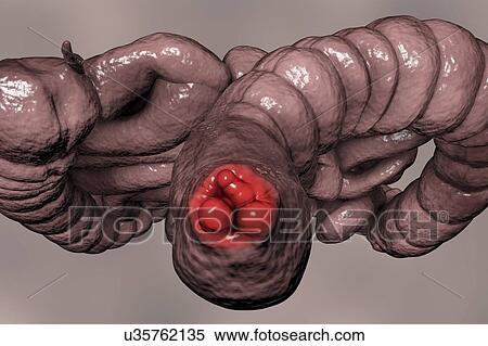 Stock Photography - Haemorrhoids. Computer illustration of human intestines from below with haemorrhoids in the anus.. Fotosearch