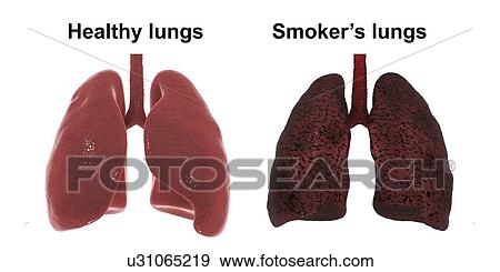Stock Photo - Healthy and smoker's lungs, computer illustration.. Fotosearch