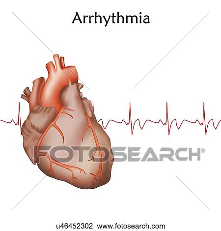 Stock Image - Heart arrhythmia, illustration. Fotosearch