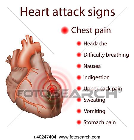 Picture - Heart attack (myocardial infarction) signs, illustration.. Fotosearch