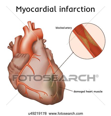 Heart attack (myocardial infarction), illustration. A blocked coronary artery has led to heart muscle damage. View Large Photo Image Stock Photo - Heart attack (myocardial infarction), illustration. A blocked coronary artery has led to heart muscle damage.. Fotosearch