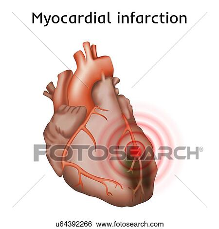 Stock Photograph - Heart attack (myocardial infarction), illustration.. Fotosearch