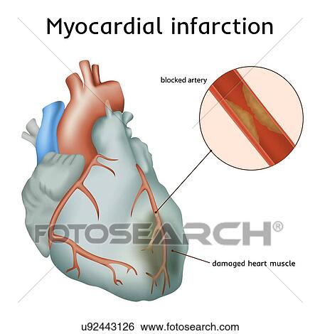 Heart attack (myocardial infarction), illustration. A blocked coronary artery has led to heart muscle damage. View Large Photo Image Stock Photograph - Heart attack (myocardial infarction), illustration. A blocked coronary artery has led to heart muscle damage.. Fotosearch