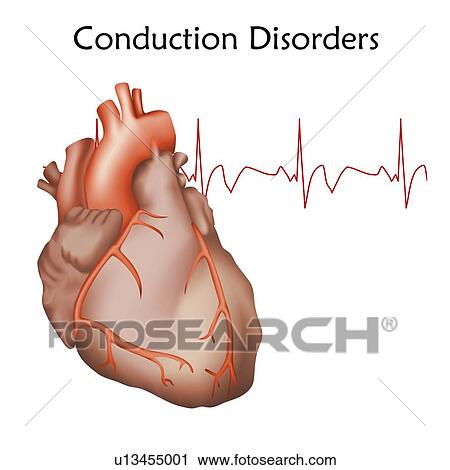 Heart conduction disorders, illustration. View Large Photo Image Stock Image - Heart conduction disorders, illustration.. Fotosearch