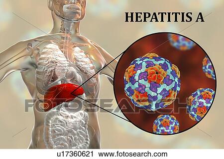 Stock Image - Hepatitis A infection. Computer illustration showing the liver and a close-up view of hepatitis A viruses.. Fotosearch