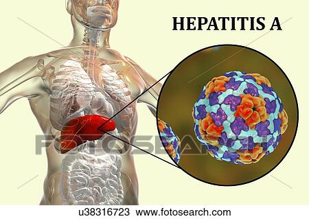 Stock Image - Hepatitis A infection. Computer illustration showing the liver and a close-up view of hepatitis A viruses.. Fotosearch