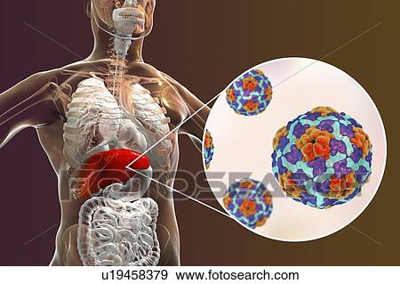 Stock Photo - Hepatitis A infection. Computer illustration showing the liver and a close-up view of hepatitis A viruses.. Fotosearch