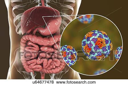 Stock Photo - Hepatitis A infection. Computer illustration showing liver and close-up view of hepatitis A viruses.. Fotosearch