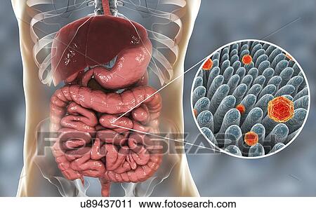 Hepatitis A viruses infecting intestine, illustration. Hepatitis A is transmitted through infected food or drink. Symptoms include influenza-like symptoms of fever and sickness, along with jaundice. View Large Photo Image Stock Image - Hepatitis A viruses infecting intestine, illustration. Hepatitis A is transmitted through infected food or drink. Symptoms include influenza-like symptoms of fever and sickness, along with jaundice.. Fotosearch